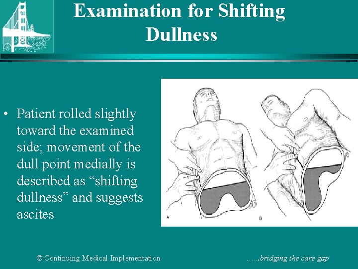 Examination for Shifting Dullness • Patient rolled slightly toward the examined side; movement of