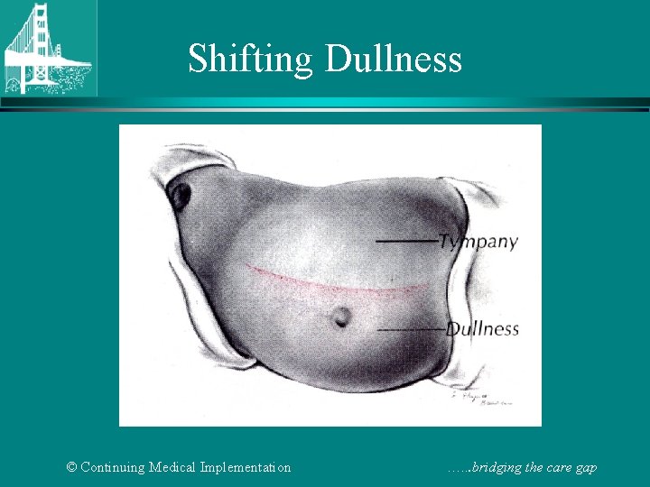 Shifting Dullness © Continuing Medical Implementation …. . . bridging the care gap 