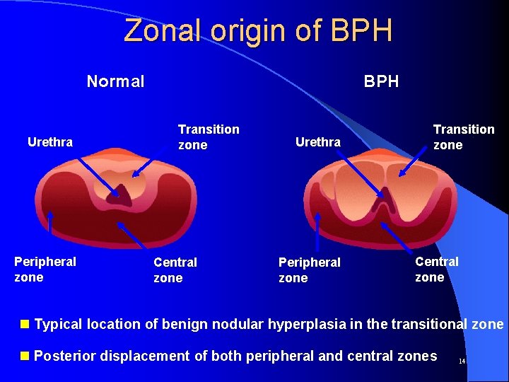 Zonal origin of BPH Normal Urethra Peripheral zone BPH Transition zone Central zone Urethra