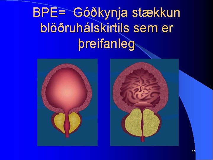 BPE= Góðkynja stækkun blöðruhálskirtils sem er þreifanleg 17 