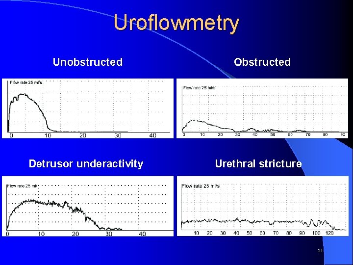 Uroflowmetry Unobstructed Detrusor underactivity Obstructed Urethral stricture 21 