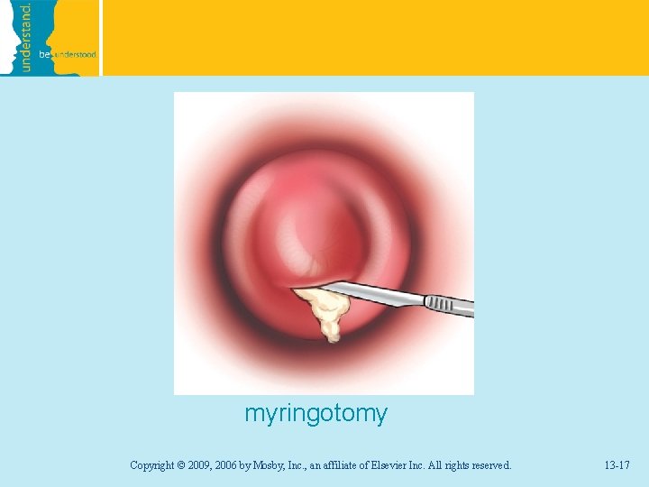 myringotomy Copyright © 2009, 2006 by Mosby, Inc. , an affiliate of Elsevier Inc.