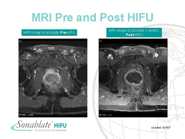 MRI Pre and Post HIFU MRI Image of prostate Pre-HIFU MRI Image of prostate