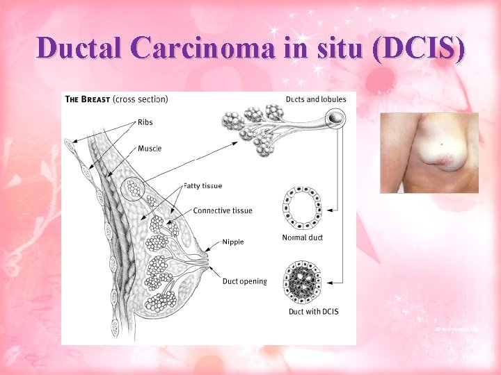 Ductal Carcinoma in situ (DCIS) 