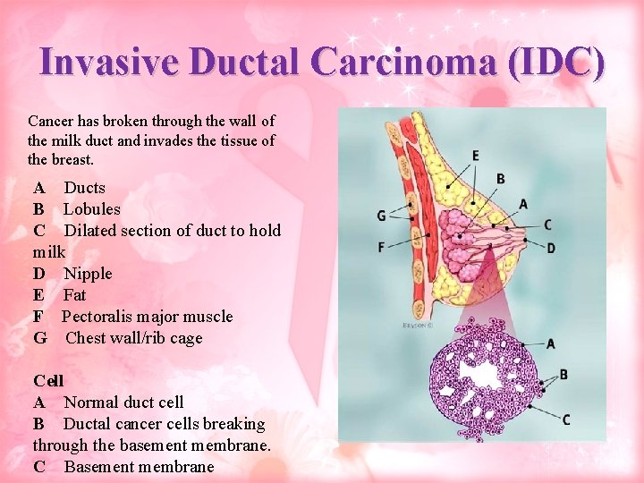 Invasive Ductal Carcinoma (IDC) Cancer has broken through the wall of the milk duct