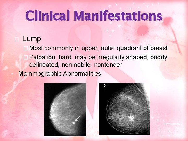 Clinical Manifestations � Lump � Most commonly in upper, outer quadrant of breast �