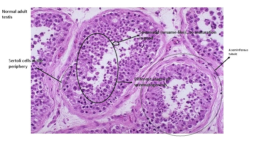 Normal adult testis Spermatid (sesame-like)…so maturation is good A seminiferous tubule Sertoli cells at