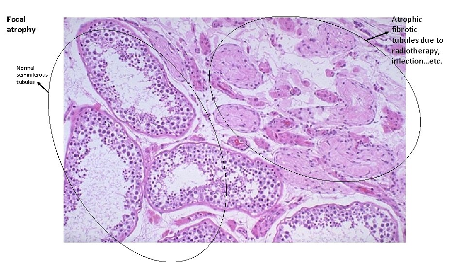 Focal atrophy Normal seminiferous tubules Atrophic fibrotic tubules due to radiotherapy, infection…etc. 