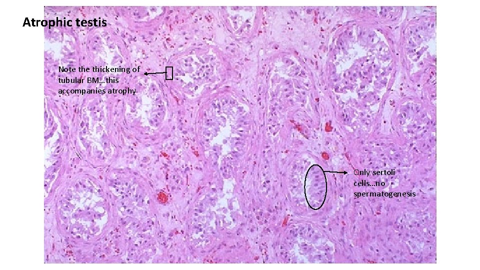 Atrophic testis Note thickening of tubular BM…this accompanies atrophy Only sertoli cells…no spermatogenesis 
