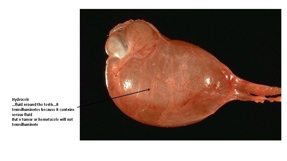 Hydrocele …fluid around the testis…it transilluminates because it contains serous fluid But a tumor