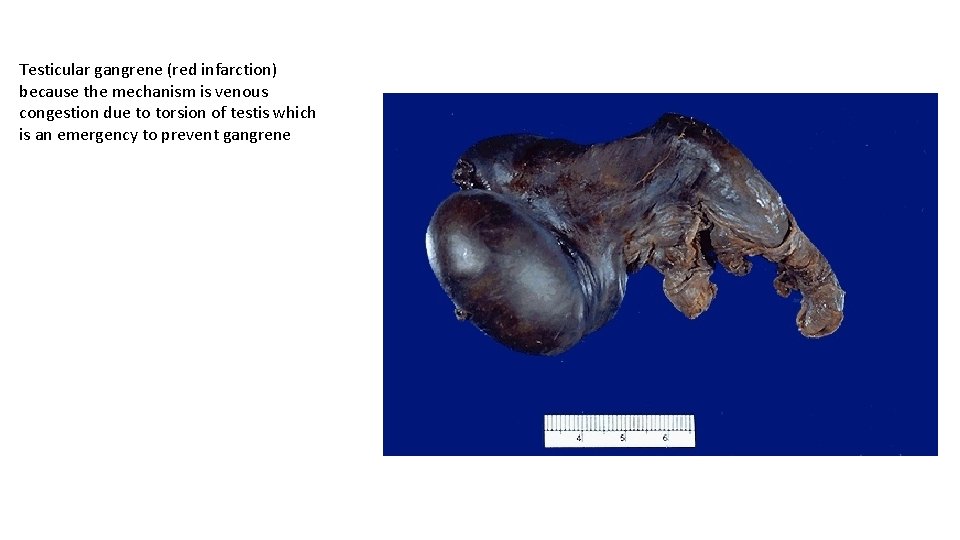 Testicular gangrene (red infarction) because the mechanism is venous congestion due to torsion of