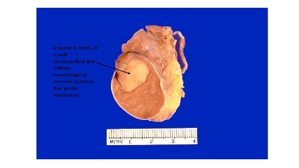 A tumor in testis…it is well circumscribed and without hemorrhage or necrosis (features that