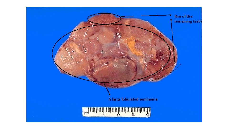 Rim of the remaining testis A large lobulated seminoma 