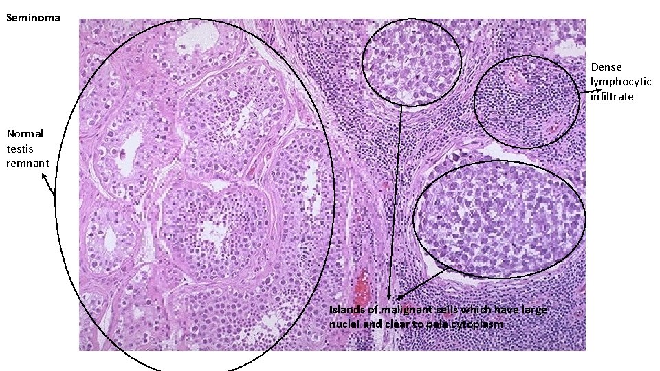 Seminoma Dense lymphocytic infiltrate Normal testis remnant Islands of malignant cells which have large