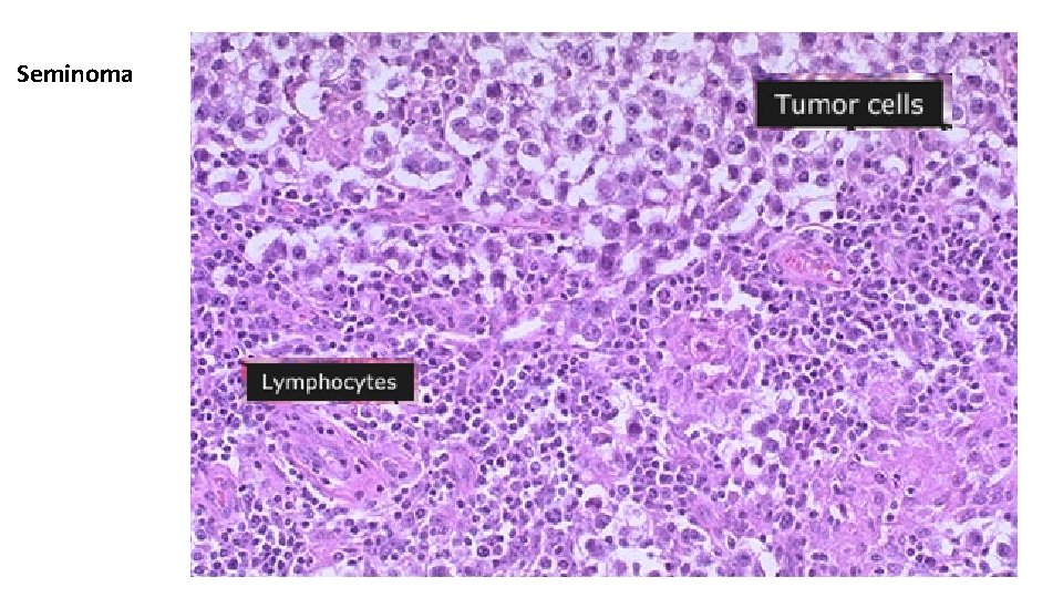 Seminoma 