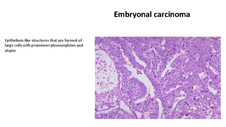 Embryonal carcinoma Epithelium-like structures that are formed of large cells with prominent pleomorphism and