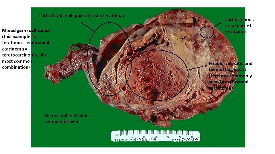 Part of cyst wall (part of cystic teratoma) Mixed germ cell tumor (this example