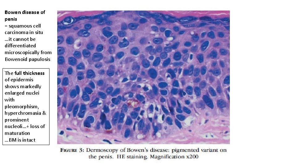 Bowen disease of penis = squamous cell carcinoma in situ …it cannot be differentiated