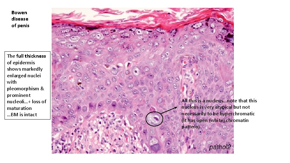 Bowen disease of penis The full thickness of epidermis shows markedly enlarged nuclei with