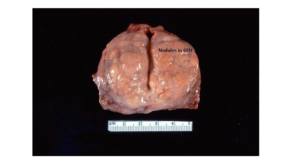 Nodules in BPH 