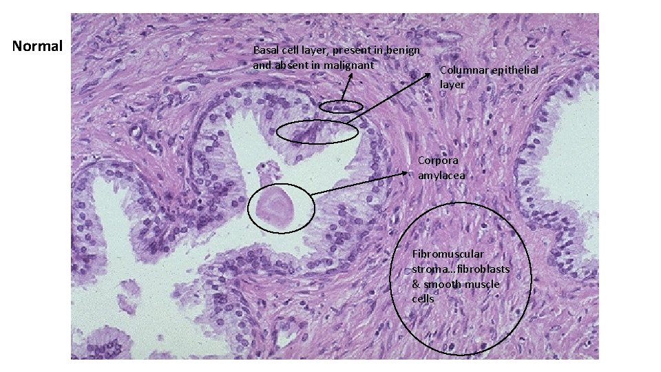 Normal Basal cell layer, present in benign and absent in malignant Columnar epithelial layer