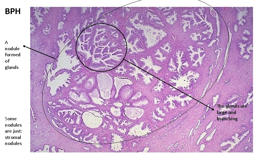 BPH A nodule formed of glands Some nodules are just: stromal nodules The glands