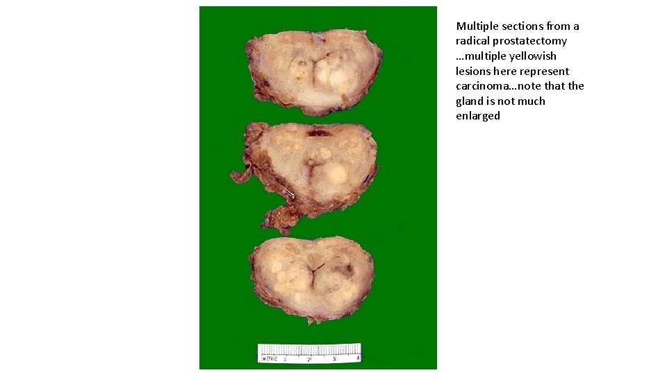 Multiple sections from a radical prostatectomy …multiple yellowish lesions here represent carcinoma…note that the