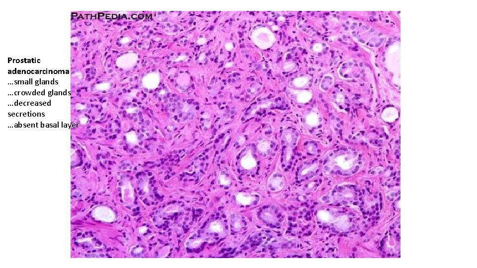 Prostatic adenocarcinoma …small glands …crowded glands …decreased secretions …absent basal layer 