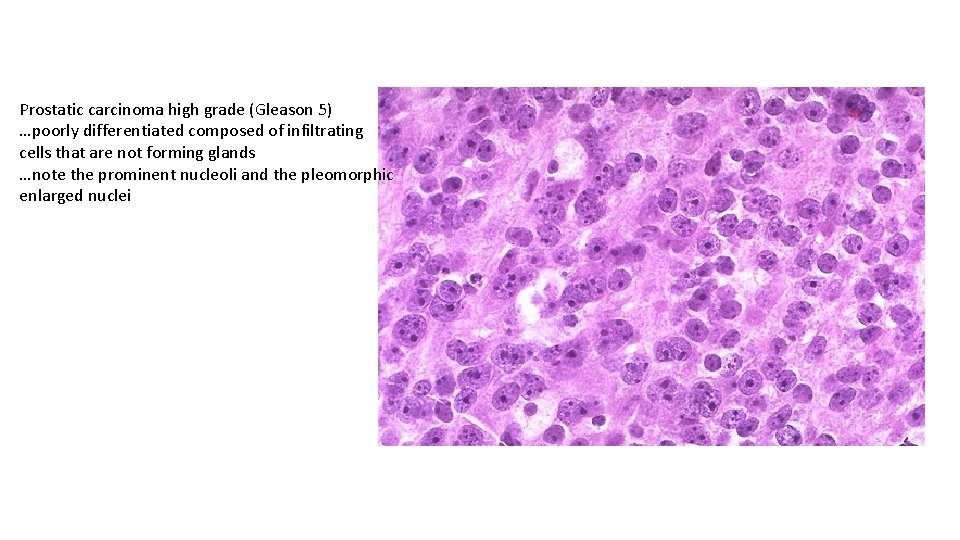 Prostatic carcinoma high grade (Gleason 5) …poorly differentiated composed of infiltrating cells that are