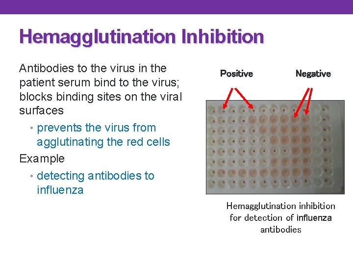 Hemagglutination Inhibition Antibodies to the virus in the patient serum bind to the virus; Hemagglutination Inhibition Antibodies to the virus in the patient serum bind to the virus;