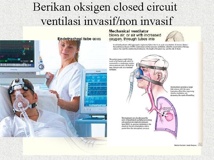 Berikan oksigen closed circuit ventilasi invasif/non invasif 