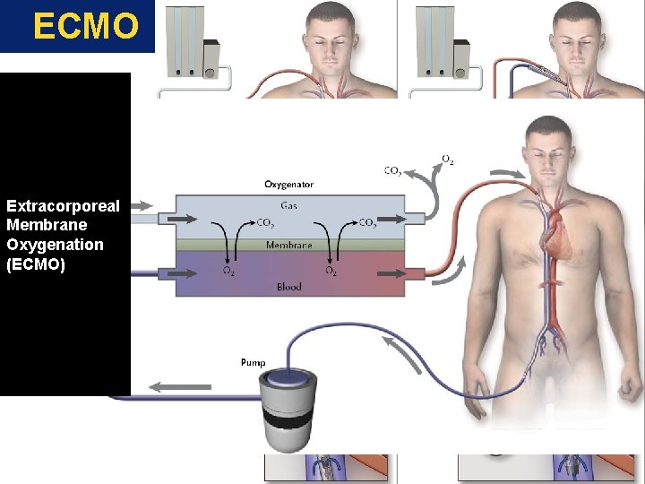ECMO Extracorporeal Membrane Oxygenation (ECMO) 