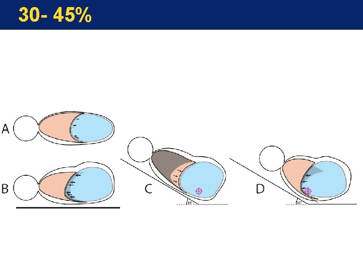 30 - 45% 