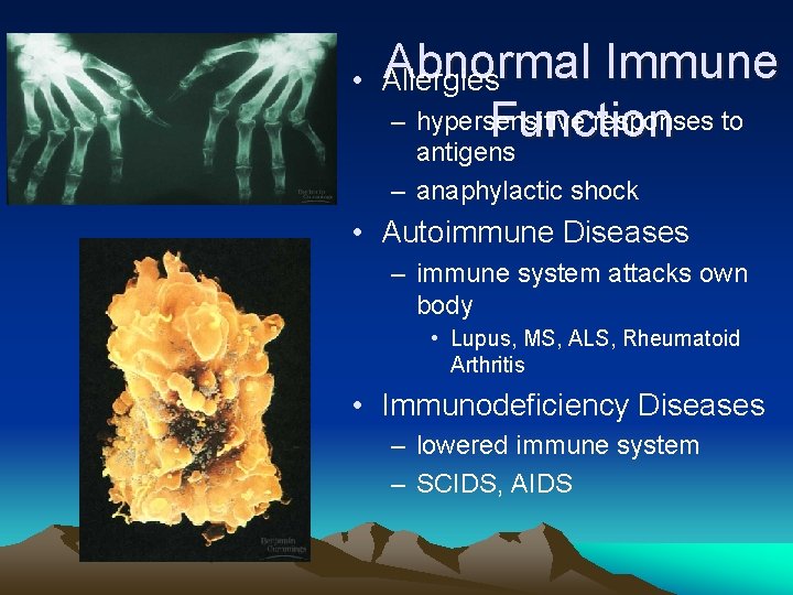 Abnormal • Allergies Immune – hypersensitive responses to Function antigens – anaphylactic shock •
