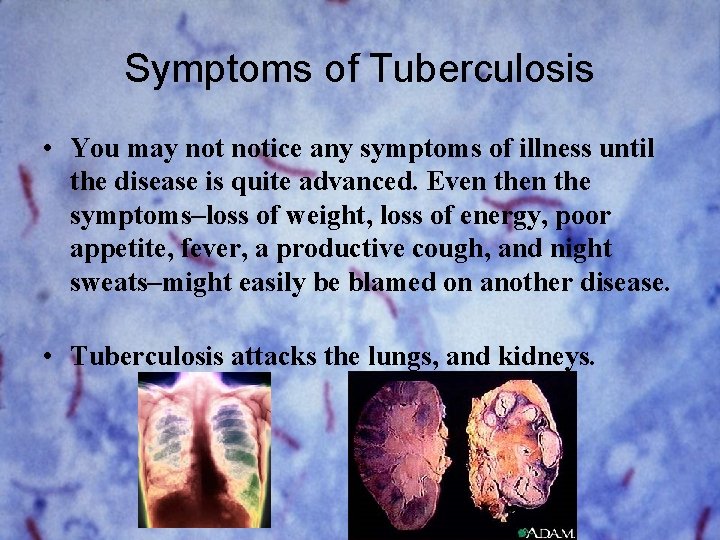 Symptoms of Tuberculosis • You may notice any symptoms of illness until the disease