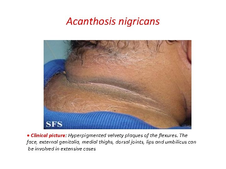 Acanthosis nigricans • Clinical picture: Hyperpigmented velvety plaques of the flexures. The face, external