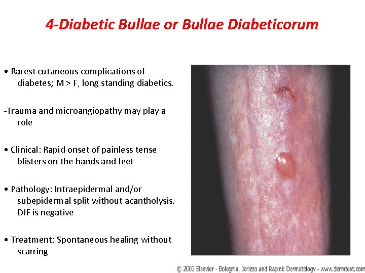 4 -Diabetic Bullae or Bullae Diabeticorum • Rarest cutaneous complications of diabetes; M >