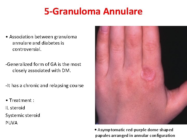 5 -Granuloma Annulare • Association between granuloma annulare and diabetes is controversial. -Generalized form
