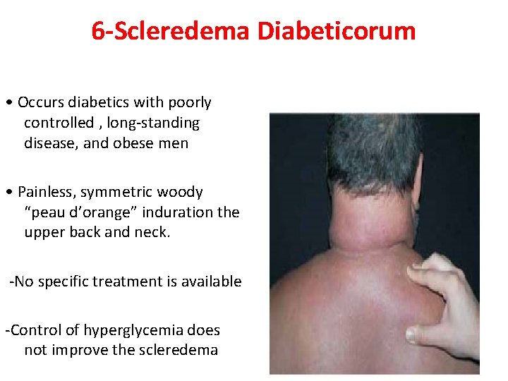 6 -Scleredema Diabeticorum • Occurs diabetics with poorly controlled , long-standing disease, and obese