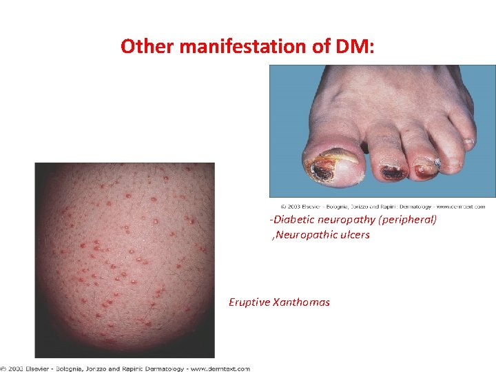 Other manifestation of DM: -Diabetic neuropathy (peripheral) , Neuropathic ulcers Eruptive Xanthomas 