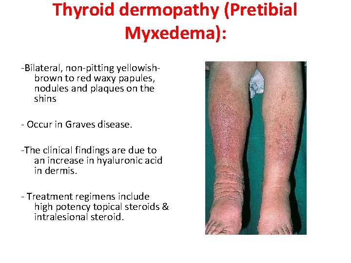 Thyroid dermopathy (Pretibial Myxedema): -Bilateral, non-pitting yellowishbrown to red waxy papules, nodules and plaques