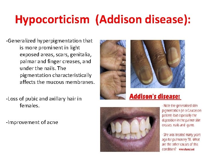 Hypocorticism (Addison disease): -Generalized hyperpigmentation that is more prominent in light exposed areas, scars,