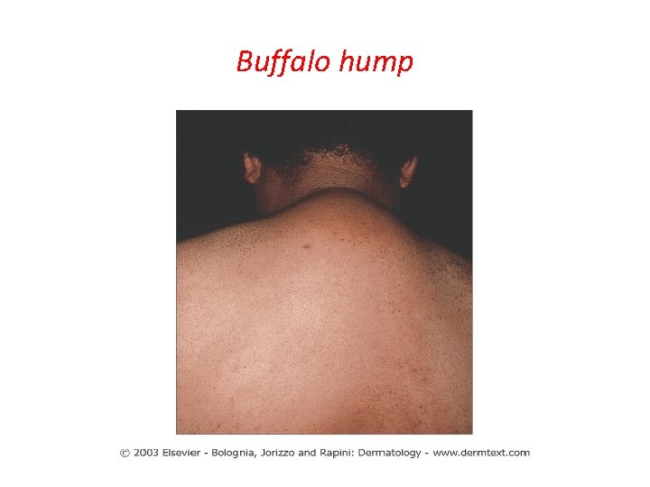Buffalo hump 