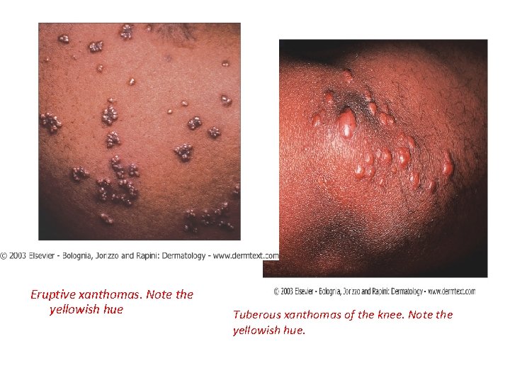 Eruptive xanthomas. Note the yellowish hue Tuberous xanthomas of the knee. Note the yellowish