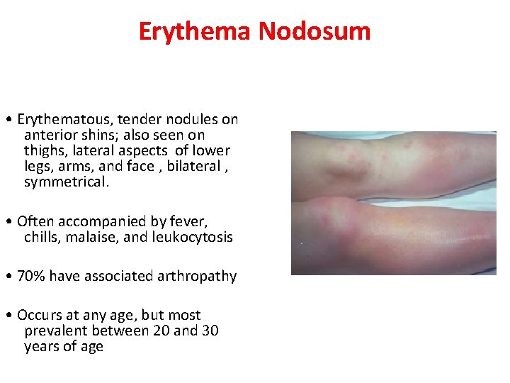 Erythema Nodosum • Erythematous, tender nodules on anterior shins; also seen on thighs, lateral