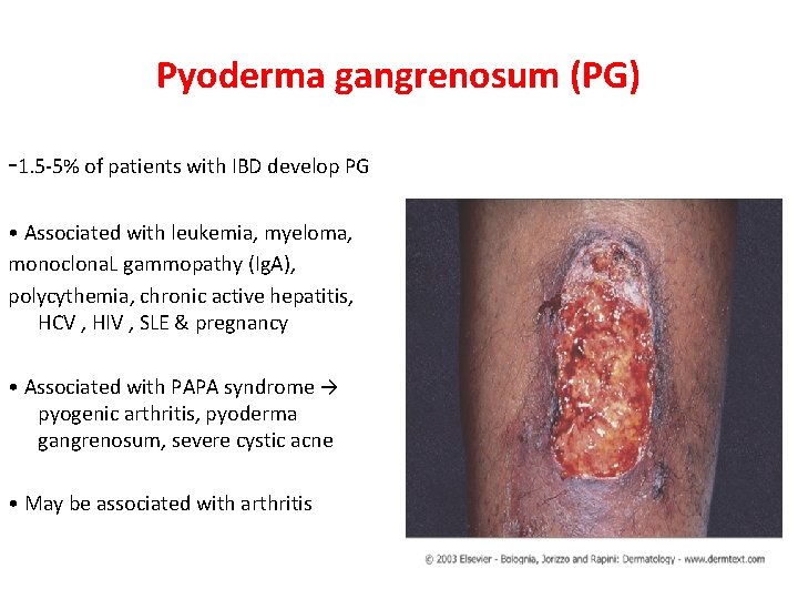 Pyoderma gangrenosum (PG) -1. 5 -5% of patients with IBD develop PG • Associated