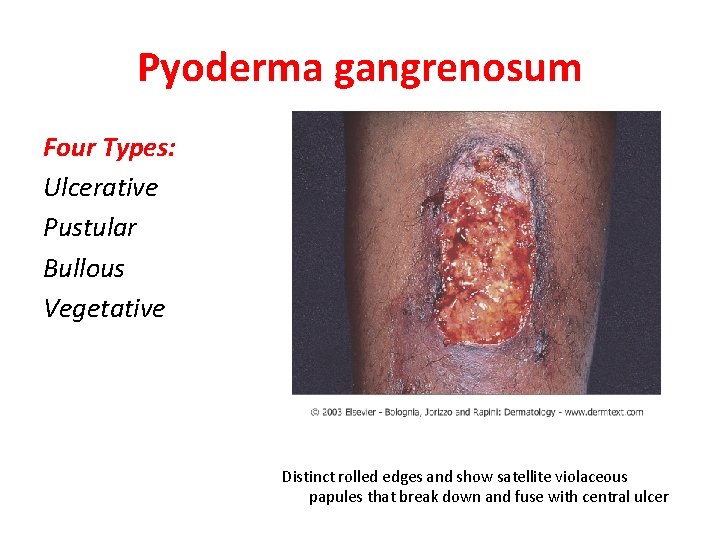 Pyoderma gangrenosum Four Types: Ulcerative Pustular Bullous Vegetative Distinct rolled edges and show satellite