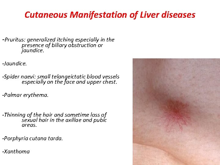 Cutaneous Manifestation of Liver diseases -Pruritus: generalized itching especially in the presence of biliary