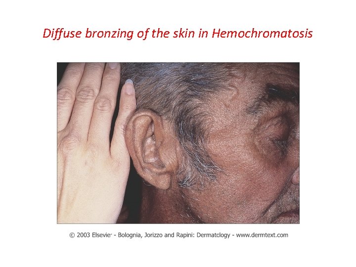 Diffuse bronzing of the skin in Hemochromatosis 