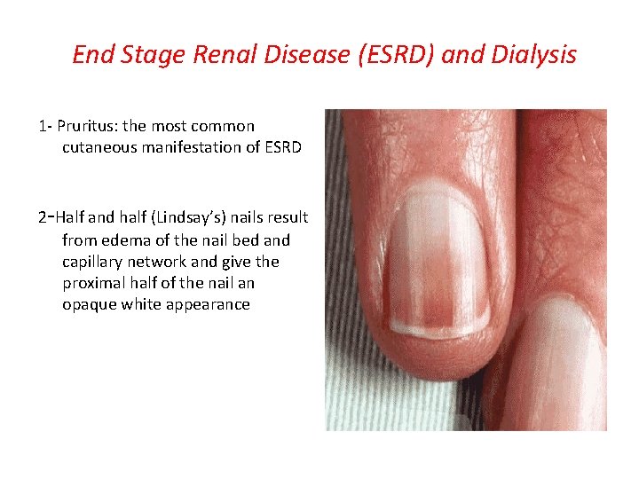 End Stage Renal Disease (ESRD) and Dialysis 1 - Pruritus: the most common cutaneous